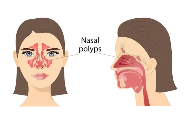 Nasal Polyps