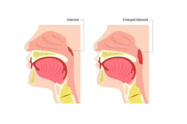 Adenoidectomy