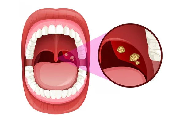 Tonsil Hypertrophy